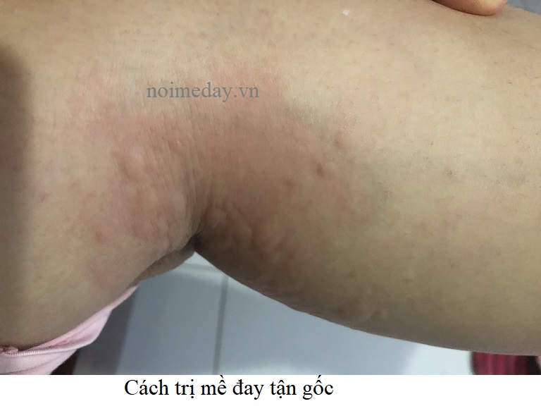 Cách trị mề đay tận gốc